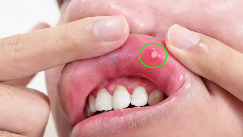 B Vitamini Eksikliği Belirtileri: Sağlığınızı Tehdit Eden 5 İşaret