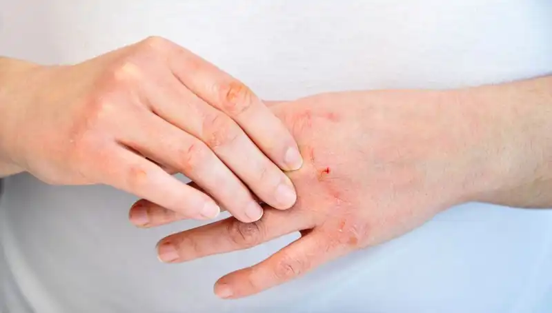 Protein Yetersizliği Belirtileri: İşte Dikkat Etmeniz Gereken 6 İşaret